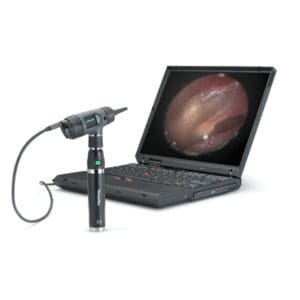 welch allyn digital macroview otoscoop